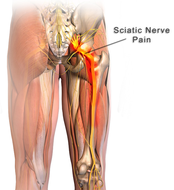 Sciatica nerve pain